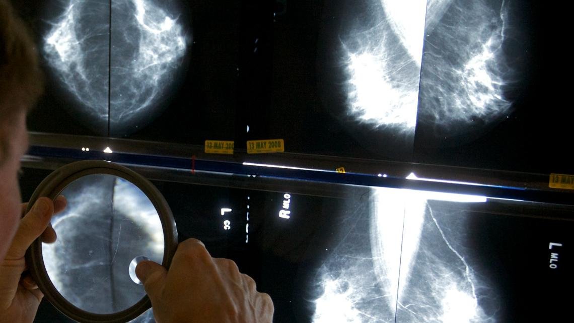 Some breast cancer patients can avoid certain surgeries, studies suggest