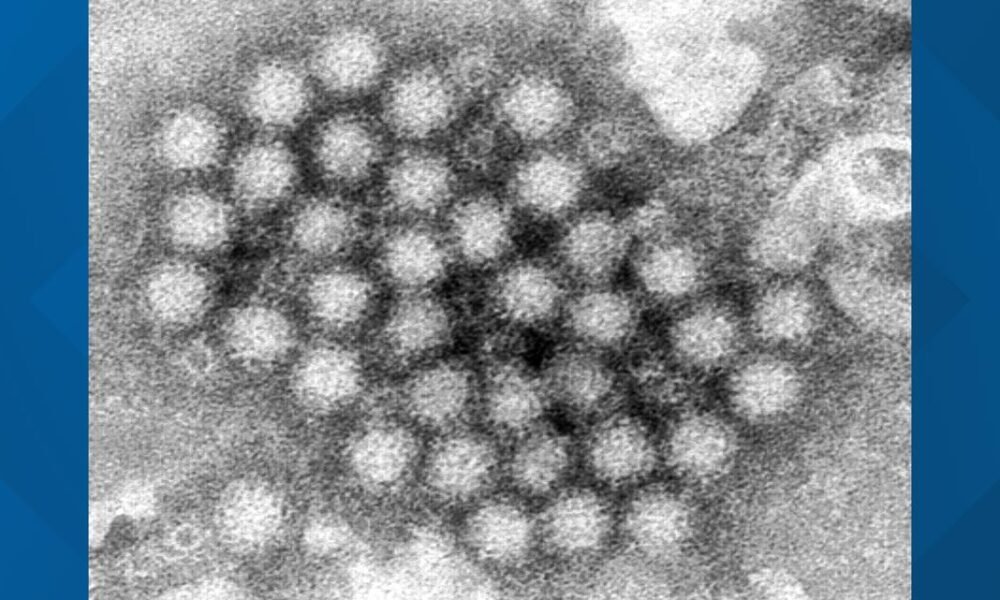 Nasty norovirus is back in full force with US cases of the stomach virus surging