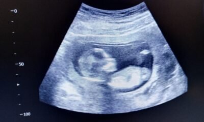 15-week ultrasound