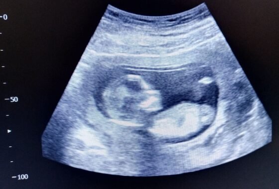 15-week ultrasound