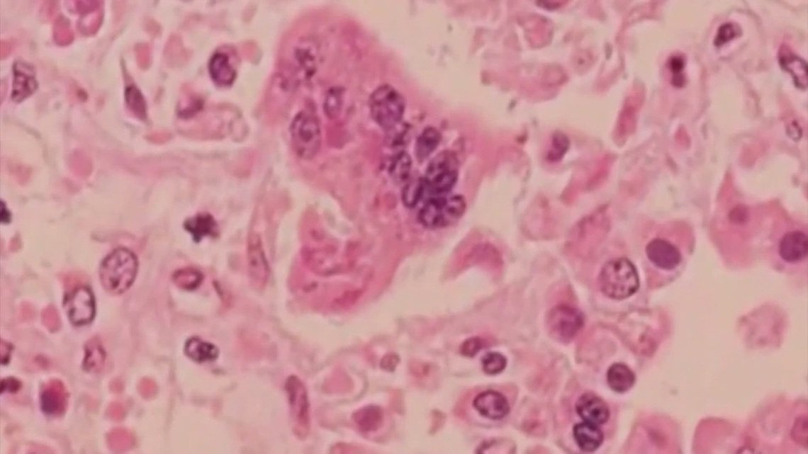 First measles death reported in West Texas outbreak was unvaccinated child, officials say