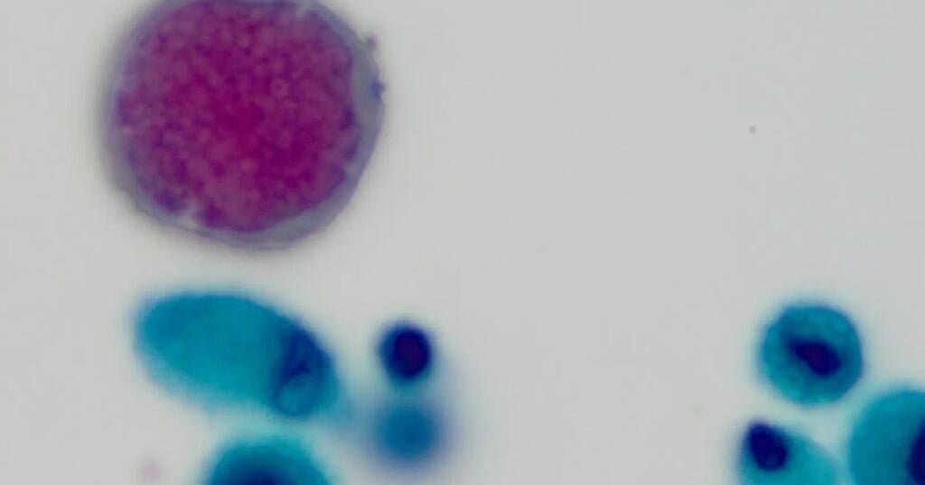 Arizona researchers look to control Valley Fever by targeting dust from dry farmland