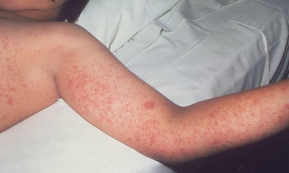 First confirmed cases of measles in Arizona in 2025