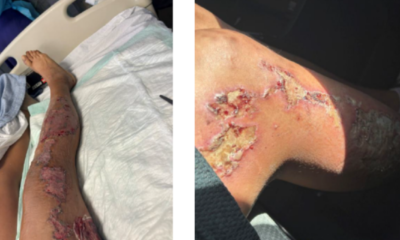 Phoenix woman sues police for causing horrible pavement burns