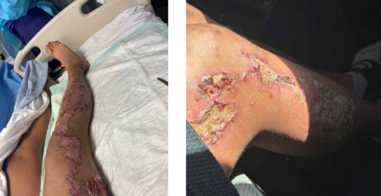 Phoenix woman sues police for causing horrible pavement burns