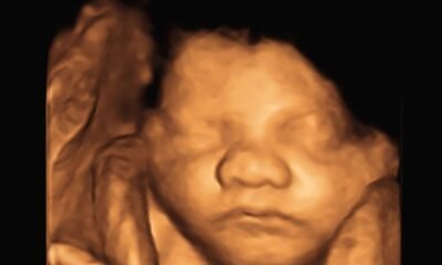 4D ultrasound