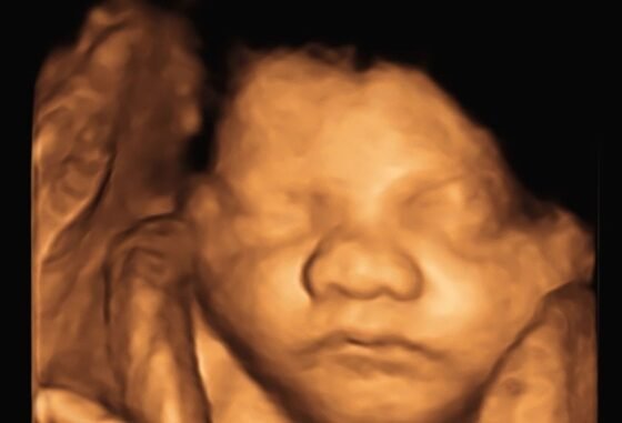 4D ultrasound