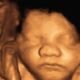 4D ultrasound